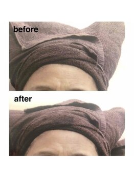 ブランシェ 高岡店 × 椿/シワ・たるみケア　お客様