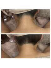 ナニワ ビューティー(naniwa beauty)/うなじ脱毛