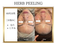 ロージー(ROSY)/ハーブピーリング/阿南/徳島