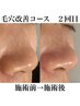 夏の毛穴美人コース☆毛穴の黒ずみ、角栓詰まり徹底改善！60分¥16000→¥12000
