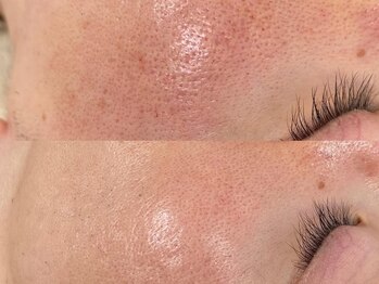 アオラ(Aola)の写真/-肌悩みに終止符を-「あ、違う…!」と施術後の変化に感動！細胞レベルから肌質改善し、自信あふれる素肌へ