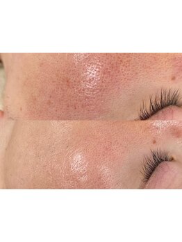 毛穴ケアをしたい