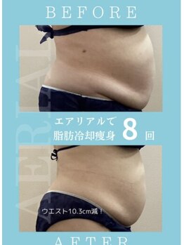 エアリアル 八代店/脂肪冷却　ウエスト10,3減♪