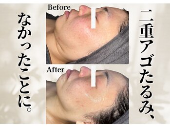 リリーシャ 赤坂(LILISHA)/40代の顔たるみに終止符。