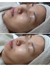 ソワナ(soina)/【神楽坂駅/フェイシャル/毛穴】