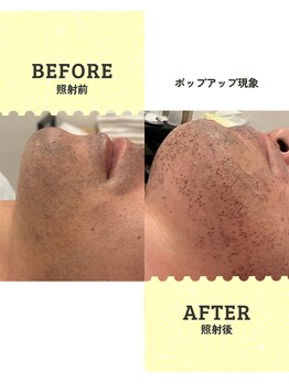 シール(Syl)/顔脱毛ポップアップ現象