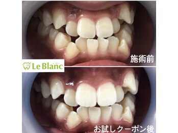 ルブラン 奈良店(Le Blanc)/着色汚れ大丈夫!?