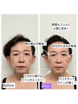 ハリ ヴァカンス(Hari Vacances)/美容鍼×三次元リフト