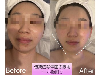 リングケー(Ling K)/マシックスティック小顔エステ