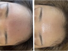 ラヴィ(Ravi)/ニキビにアプローチ