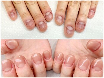 劇 的☆メンズ深爪改善！