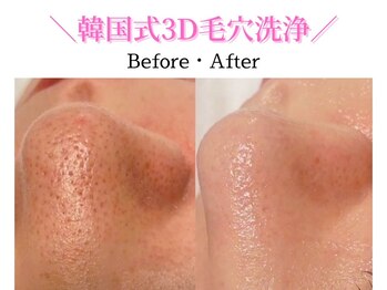 ダイヤモンド リーエンダ(Diamond leende)の写真/<角質/黒ずみ/凸凹改善>憧れの“水光肌”毛穴レス陶器肌!キュッと締まった滑らか肌実感◎韓国式3D毛穴洗浄