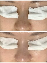 ルル(RuRu)/毛穴洗浄