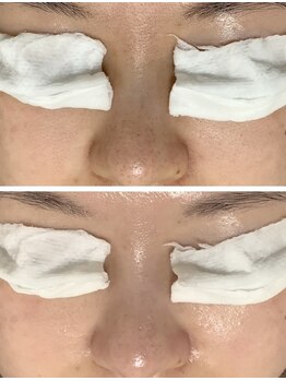 ルル(RuRu)/毛穴洗浄