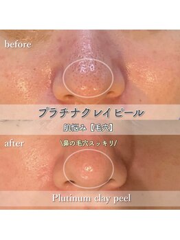 シルビー(CILBE)/ハーブトリートメント