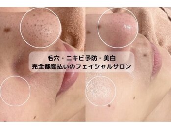 ミュー 岡崎店(mieux)/◇肌質改善◎肌に優しい毛穴ケア