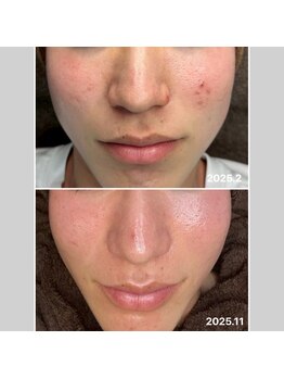 ヴィヴ フォー アール(VIV for R)/赤ニキビのお悩み改善 20代男性