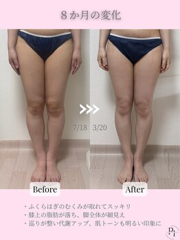 プラスワンビューティテン 新大阪店(Plus One Beauty)/ボディ/ハイパーナイフ/痩身