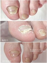 ディグニティ(Dignity)/分厚く変色した爪(肥厚爪)ケア