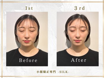 シルク(SILK)の写真/【小顔矯正・顔の歪み矯正専門サロン】顔が歪むことによって、エラ張り・顔のたるみ・左右差がおこる！？