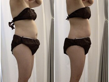 ポルトボーテ(Porte Beaute)の写真/【韓国進化系インディバ】全身リンパ流し！脂肪を分解＆燃焼で老廃物の排出を促進し痩せやすい身体作りを◎