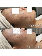 ニュアージュ(Nuage)/30代女性　ニキビケア途中経過