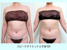 リクラ(Reclat)/スピードダイエット上半身1回