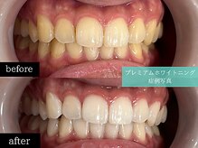 ホワイトニングカフェ 博多駅前店(WhiteningCafe)/◎歯のホワイトニング施術写真◎