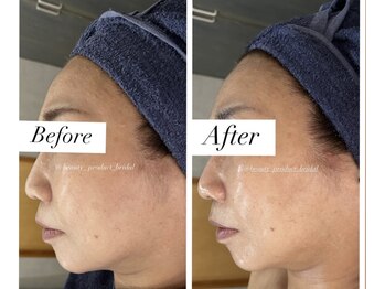 ビューティープロダクト(Beauty product)/小顔リフト&デコルテ