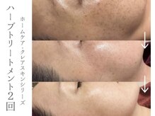 ミミルーチェ(mimiluce)の雰囲気（10回のエステより1回のハーブ/肌質改善特化ハーブピーリング使用）
