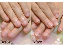 リファーレ(RIFARE)/【深爪矯正】初回長さ出し有◎