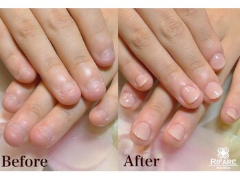 リファーレ(RIFARE)/【深爪矯正】初回長さ出し有◎