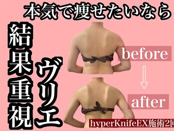 エステサロン ヴリエ 立川店/★ハイパーナイフEX2回★花嫁様