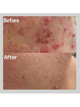 ヴィヴ フォー アール(VIV for R)/赤ニキビのお悩み改善 20代男性