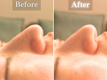 ボーンオム(Born Homme)/毛穴洗浄＋美容液導入：20代女性