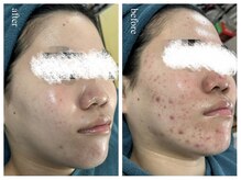 リノルーア(Linolua)の雰囲気（繰り返す大人ニキビに対応）