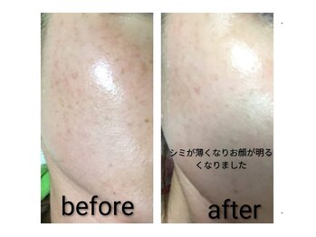 アリー(Alii)/グリーンピール5Days