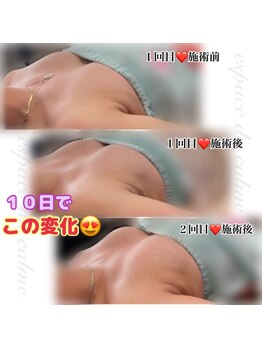 カルマーアンドビー(Calmer & Be.)/【バスト】Before/After