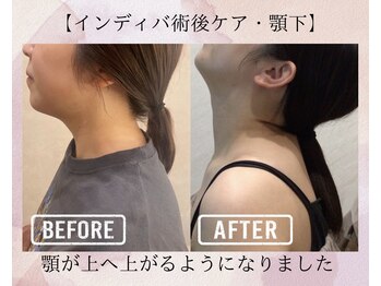 オキシー グレイス 小倉店(OXY Grace)/【インディバ術後ケア・顎下】