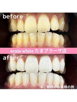 エクシアホワイトニング たまプラーザ店/ビフォーアフター