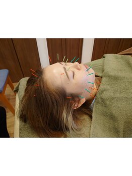 鍼灸施術を受けたい