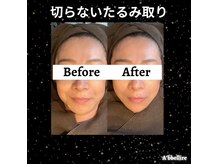 アッヴェリーレ(A'bbellire)の雰囲気（たるみ改善でスッキリ小顔♪）
