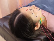 F.C.C.あやせ鍼灸整骨院/美容鍼【綾瀬/鍼灸】