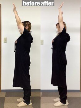 イロハ鍼灸整骨院 豊中市役所前院(IroHa鍼灸整骨院)/イベントに向け姿勢改善!