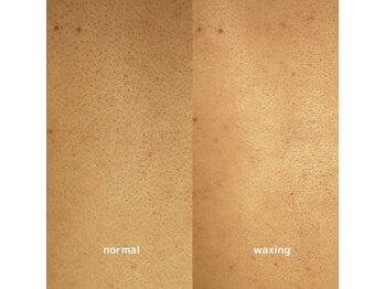 キエズ(KIES)/背中ワックス脱毛