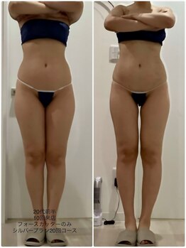 プラチナアース 守谷店(Platinum earth)/痩身ビフォーアフター