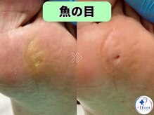 プラスワンフット 本厚木(+1 Foot)/タコ・魚の目ケア！痛みから解放