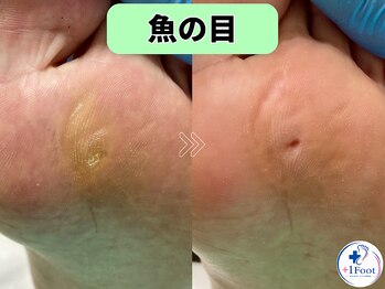 プラスワンフット 本厚木(+1 Foot)/タコ・魚の目ケア！痛みから解放