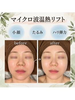 インナーグロウ 中目黒(INNER GLOW)の写真/30代からの「落ちてきた?」を速攻ケア!最新のマイクロ波×レッボトルトで、自分史上最高の小顔へ♪