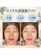 インナーグロウ 中目黒(INNER GLOW)の写真/30代からの「落ちてきた?」を速攻ケア!最新のマイクロ波×レッボトルトで、自分史上最高の小顔へ♪
